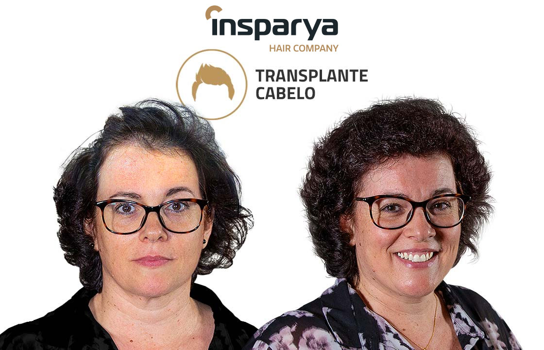 Transplante Capilar Antes e Depois, Carla Quintanilho