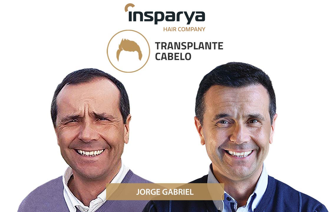 Transplante Capilar Antes e Depois, Jorge Gabriel